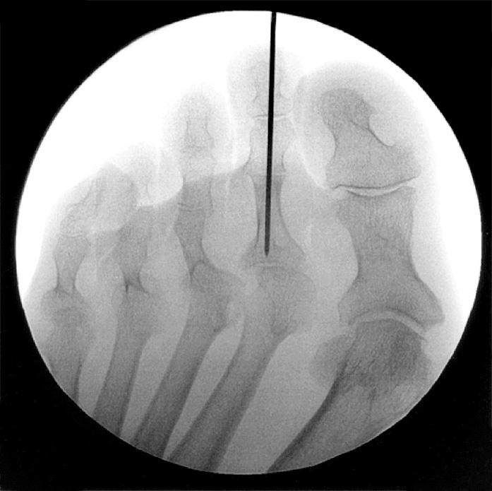 Image B shows a modern X-ray of a patient s foot. (a) John says image B is better than image A. Suggest why.