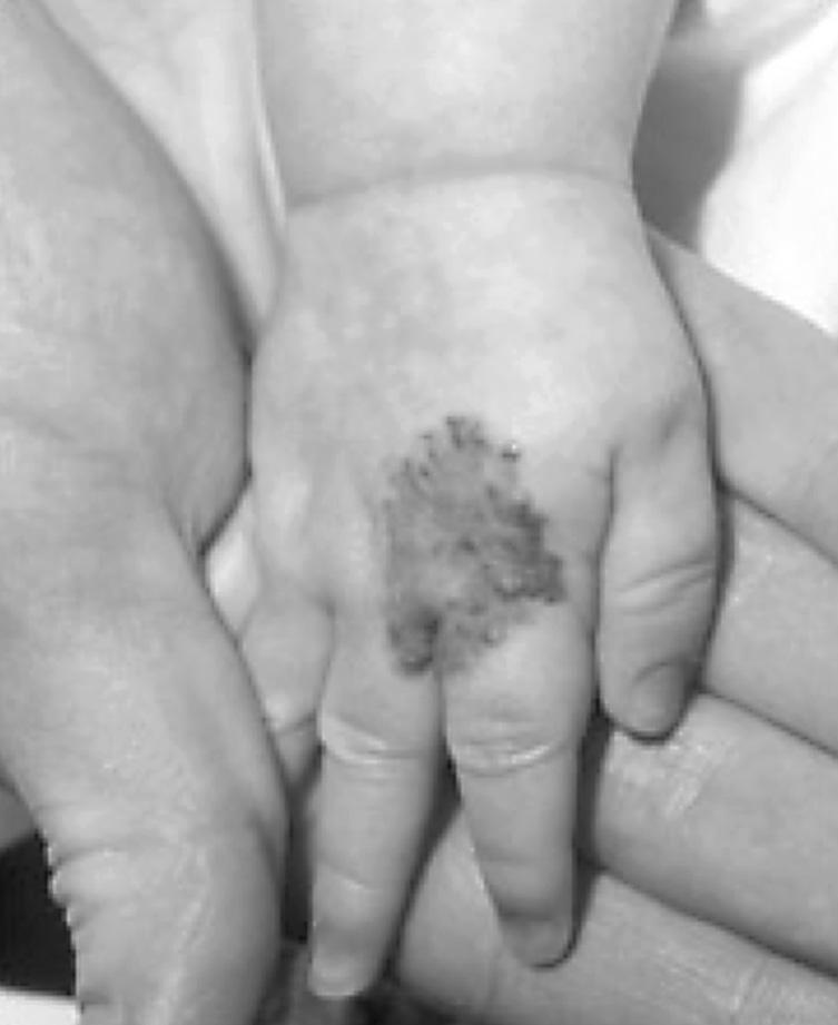 (ii) Another early claim was Baby has birthmark removed by X-rays. The photograph shows an example of a birthmark. 1. Complete the following sentence by putting a cross ( ) in the correct box.