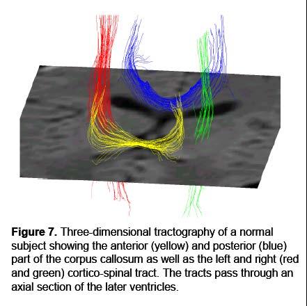 Diffusion Tractography Follow Voxels With Largest Eigenvalues Being Continuous Between Two Regions of Interest Courtesy of Dr. Martha Shenton.