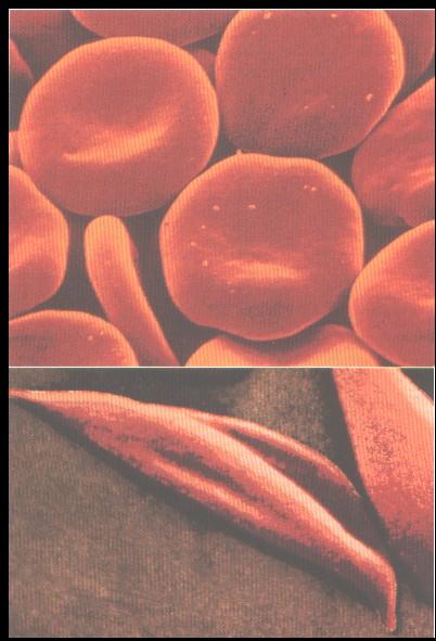 Sickle Cell Anemia: An example of Chemical Evolution Normal individuals Normal Red Blood Cells Red blood cells normally adopt a flexible, biconcave disk shape Allows cells to pass through very small