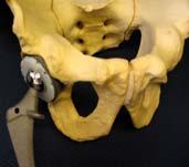 RADIATION CROSSLINKING Total hip replacement Ultra-high