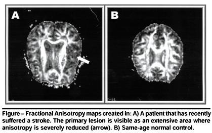 Applications: Diffusion MRI emerging as a routine clinical protocol Ischemia Stroke MS