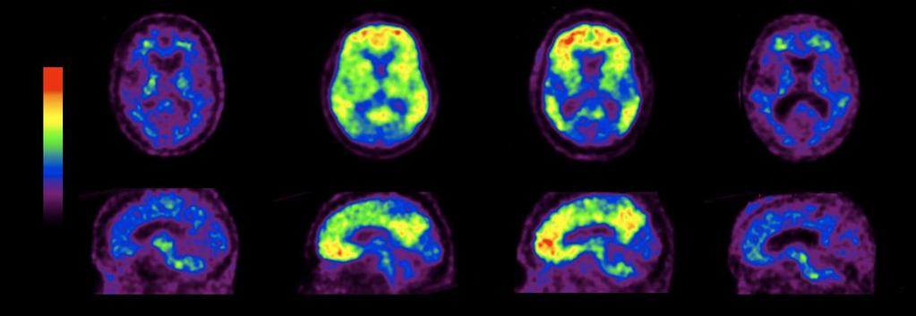 Neuronal Degenerative Diseases Healthy Control Lewy Body Alzheimer s