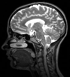 Matter White Matter) T2 Weighted Image (T2WI)