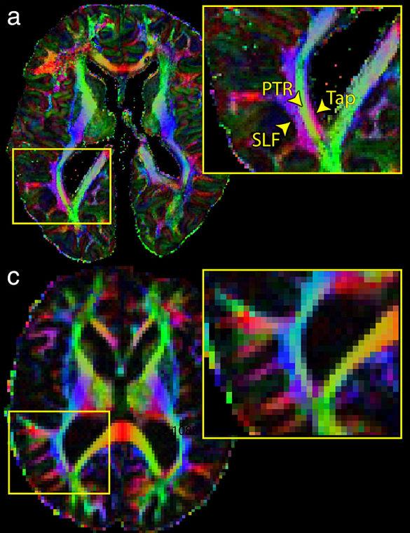 Human multiscale connectivity Macroscale Mesoscale Microscale Nanoscale In-vivo dmri Ex-vivo LM Ex-vivo dmri Ex-vivo EM µm 3 : whole human brain 10 15 Long-range Short-range Topographic Layered