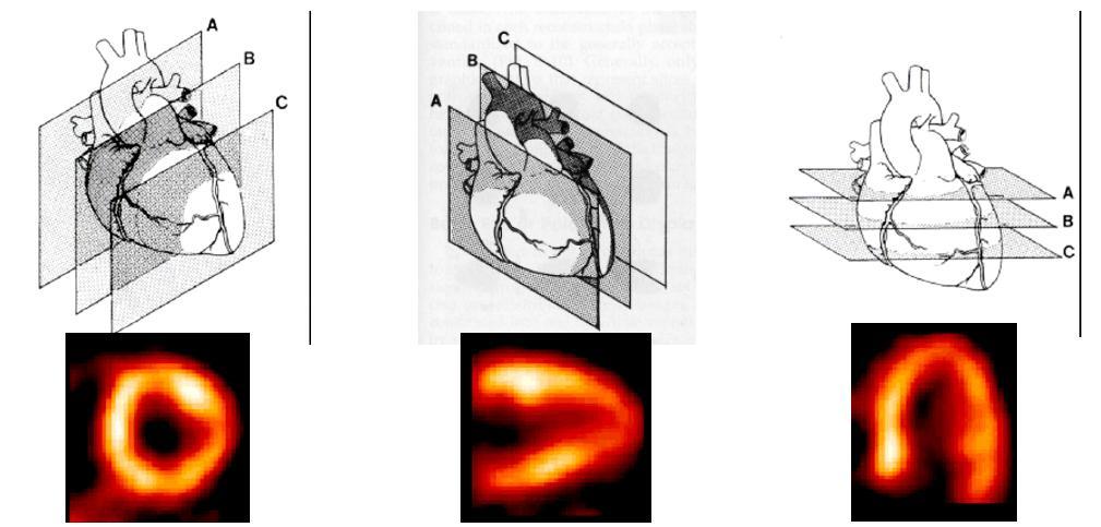 Nuclear Medicine Single Photon Emission Tomography - SPECT Myocard SPECT 99mTc MIBI (methoxyisobutylisonitrile)