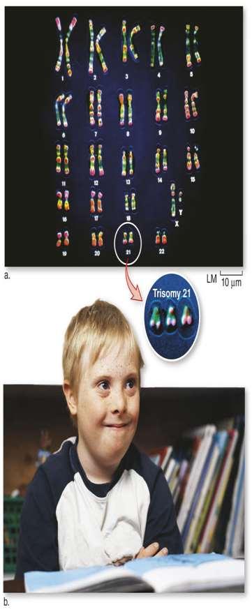 Errors Sometimes Occur in Meiosis An extra copy of a chromosome a trisomy causes genetic disorders such as Down syndrome.