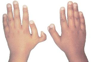 Ellis-van Creveld syndrome Other symptoms of this disease include dwarfisms,