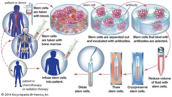 Stem Cell Therapy Based on the concept of tissue repair by adult stem cells Currently most widely used in cancer therapy