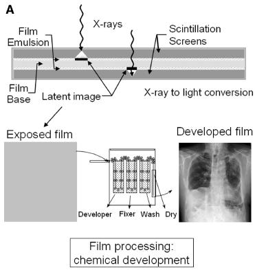 The most common type of the analog detector for X-ray imaging is screen-film cassette, which consists of intensifying screen (a phosphor, or scintillation