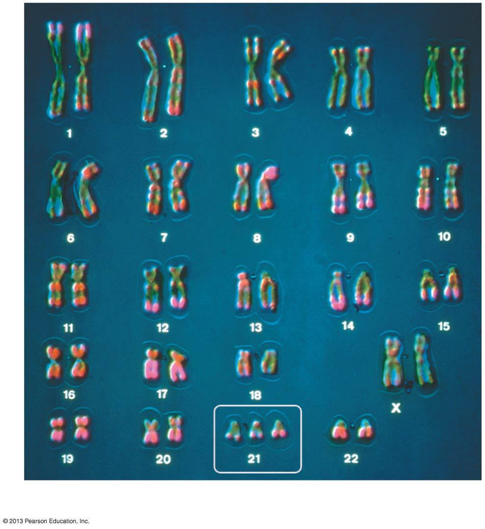 chromosome 21, and affects about one out of every 700 children.