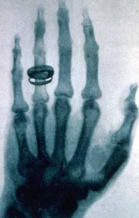 1st x-ray photograph Bertha s