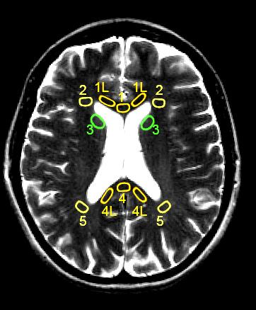 Results_Human Brain MD*10-3 mm 2 /s FA MNG ANG ROI1 0.86±0.34 0.83±0.10 175±71 0.87±0.13 ROI1L 0.82±0.23 0.