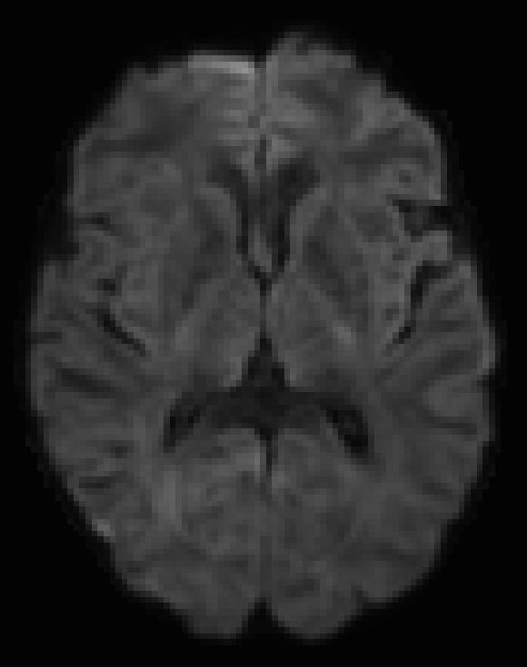 3 Correction of Image Artifacts While dmri provides us with measurements of diffusion, it must be acknowledged that the quality of the diffusion weighted images is affected and limited by the image
