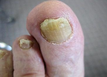 Examples: Ringworm, Athlete s foot, Jock itch, fingernail and toenail