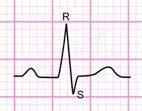 deflection RS deflection The measured EKG can be compared to normal and abnormal HMM to detect cardiac