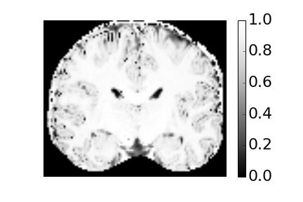 In the top row, we show Fractional Anisotropy (FA) and Propagator Anisotropy (PA) of Diffusion Tensor Imaging (DTI), PA by Mean Apparent Propagator (MAP)-MRI and micro- FA by Spherical Mean Technique