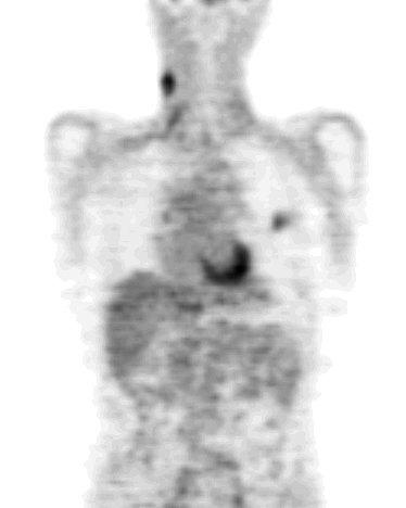 PET: Radiopharmaceuticals [ 18 F]FDG Primary tumour in the neck with lung