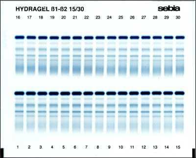 Electrophoresis examples from clinical medicine separation of serum proteins, isoenzymes, nucleic acids