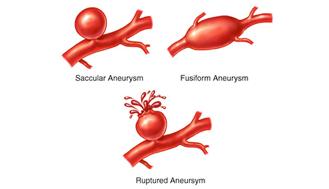 Aneurysms Is the PRESSURE higher in a normal blood vessel or in region with aneurysm? saccular aneurysm fusiform aneurysm Q96 A. Normal blood vessel B. Aneurysm C.