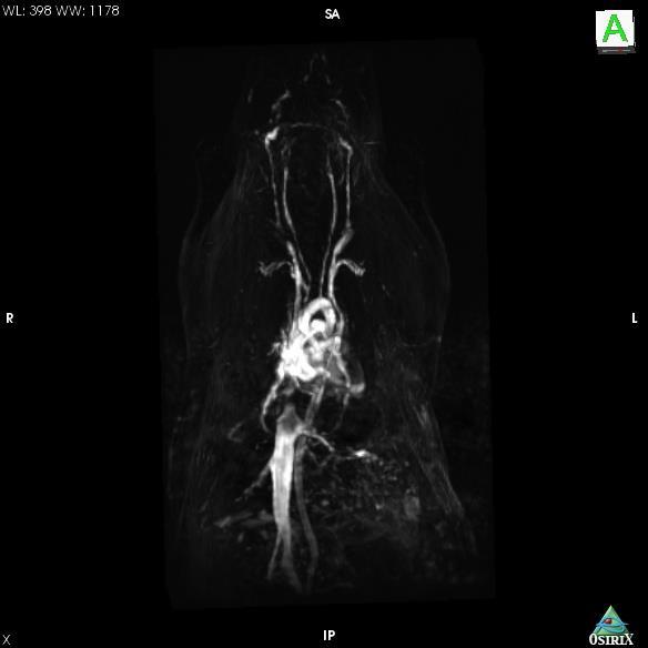 Cava Aortic Arch Aorta Was able to image blood vessel of < 200 m M (emu/g) 6 3 0-3 -6 Nearly