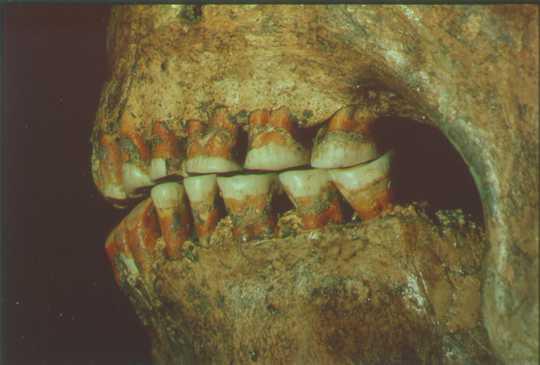 Wear on teeth: Neanderthals