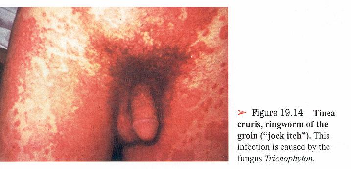 Tinea cruris ringworm infection; a fungal infection
