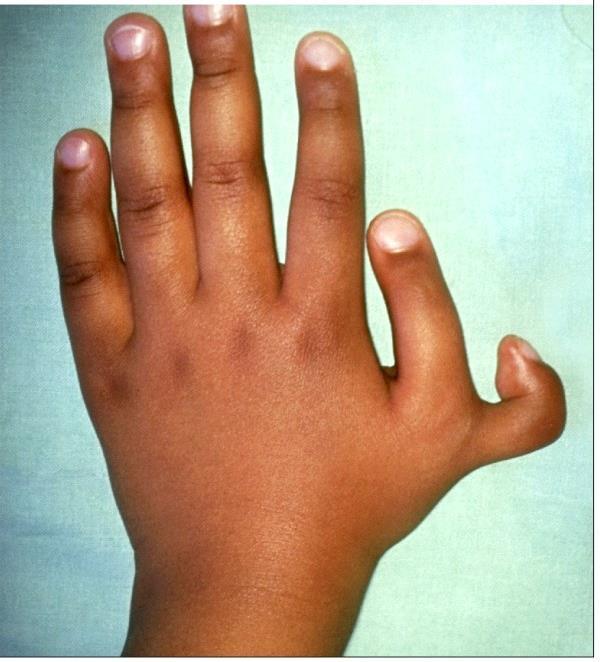 Do Now: Amish people are prone to polydactyly (extra fingers and toes). The Amish population in the U.S.